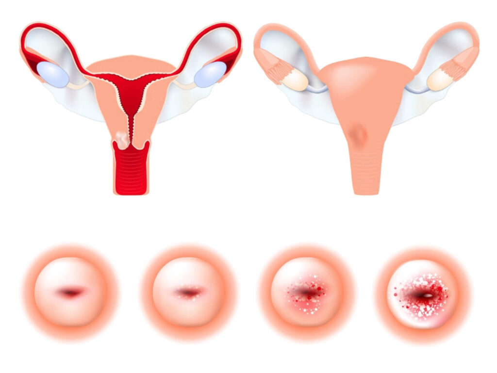 Hướng dẫn cách thực hiện tầm soát ung thư cổ tử cung